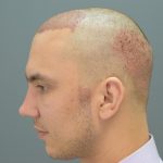 Обучение пересадке волос: комплексный подход к восстановлению волос